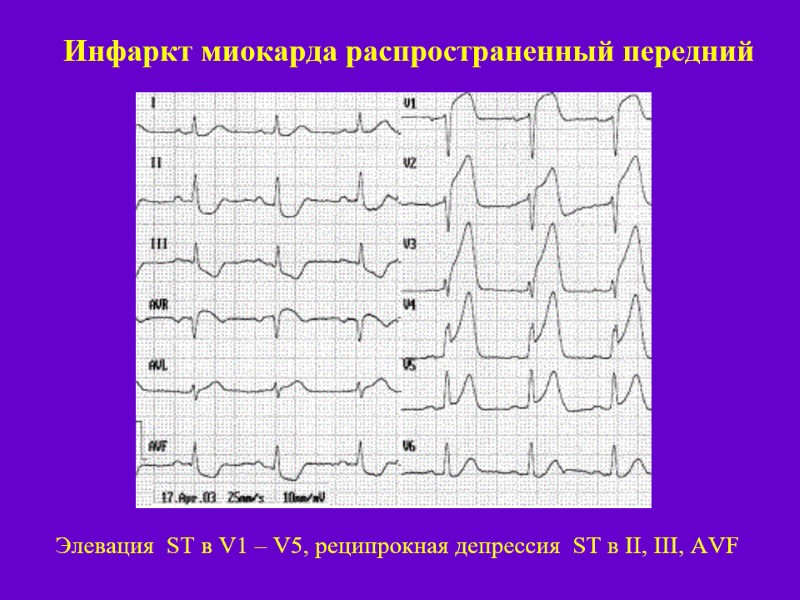 Инфаркт миокарда распространенный передний Элевация  ST в V1 – V5, реципрокная депрессия 